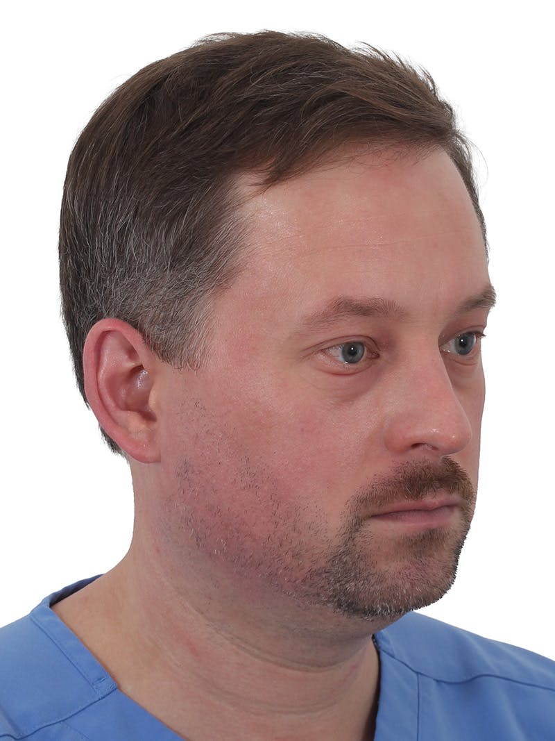 Facelift/Neck Lift Before & After Gallery - Patient 366161 - Image 3