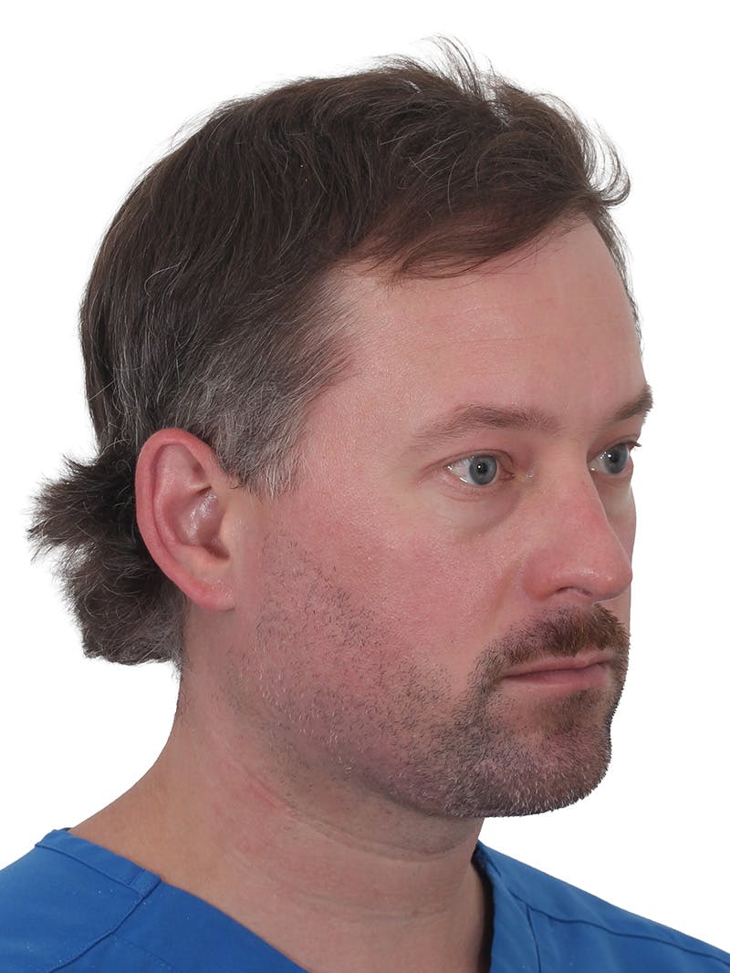 Facelift/Neck Lift Before & After Gallery - Patient 366161 - Image 4