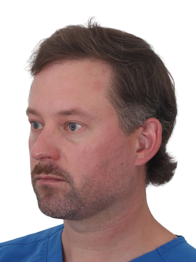 Facelift/Neck Lift Before & After Gallery - Patient 366161 - Image 10