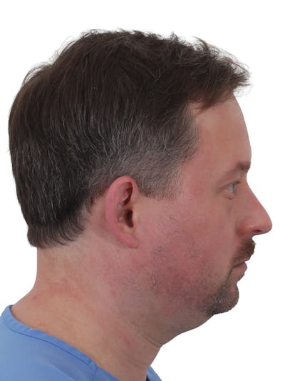 Chin Augmentation Before & After Gallery - Patient 346008 - Image 1