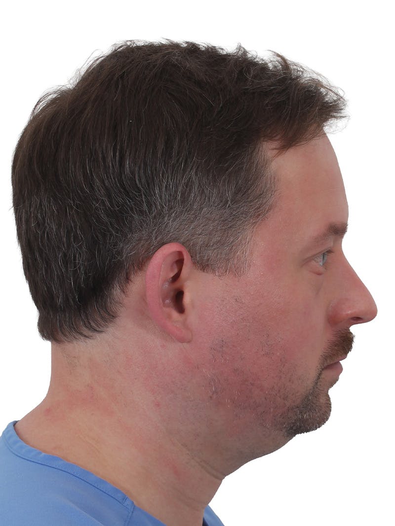 Facelift/Neck Lift Before & After Gallery - Patient 366161 - Image 1