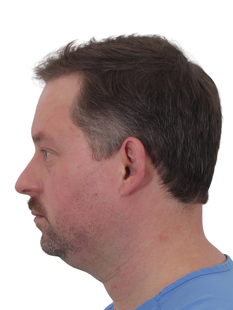 Facelift/Neck Lift Before & After Gallery - Patient 366161 - Image 5