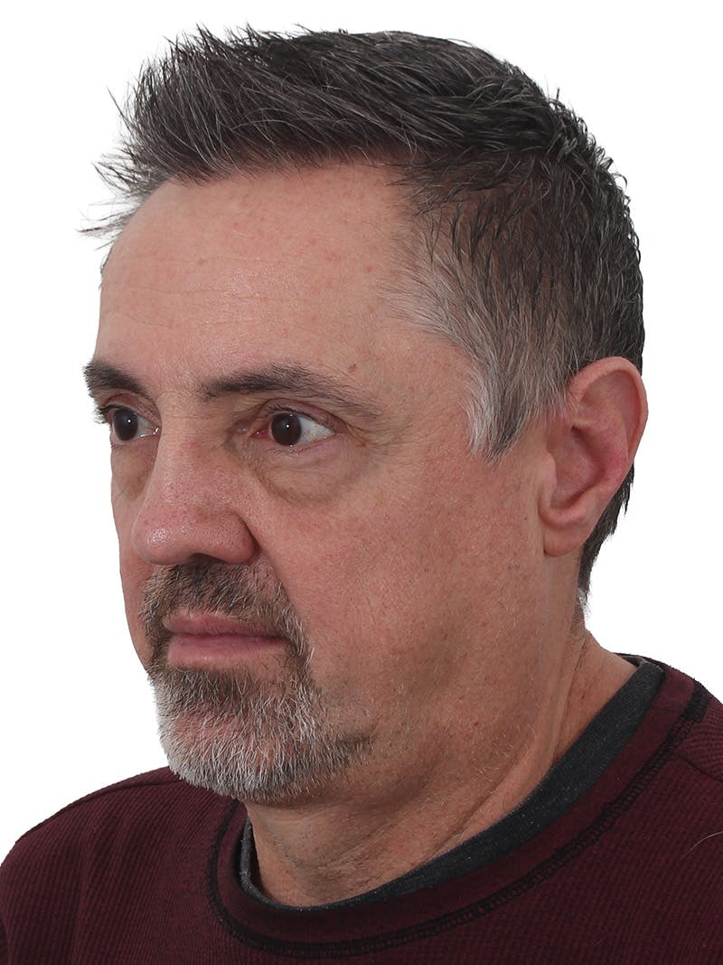 Blepharoplasty Before & After Gallery - Patient 266889 - Image 3