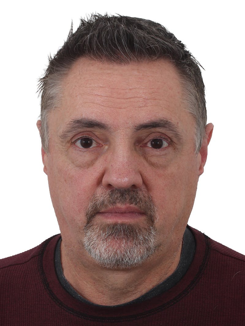 Blepharoplasty Before & After Gallery - Patient 266889 - Image 1