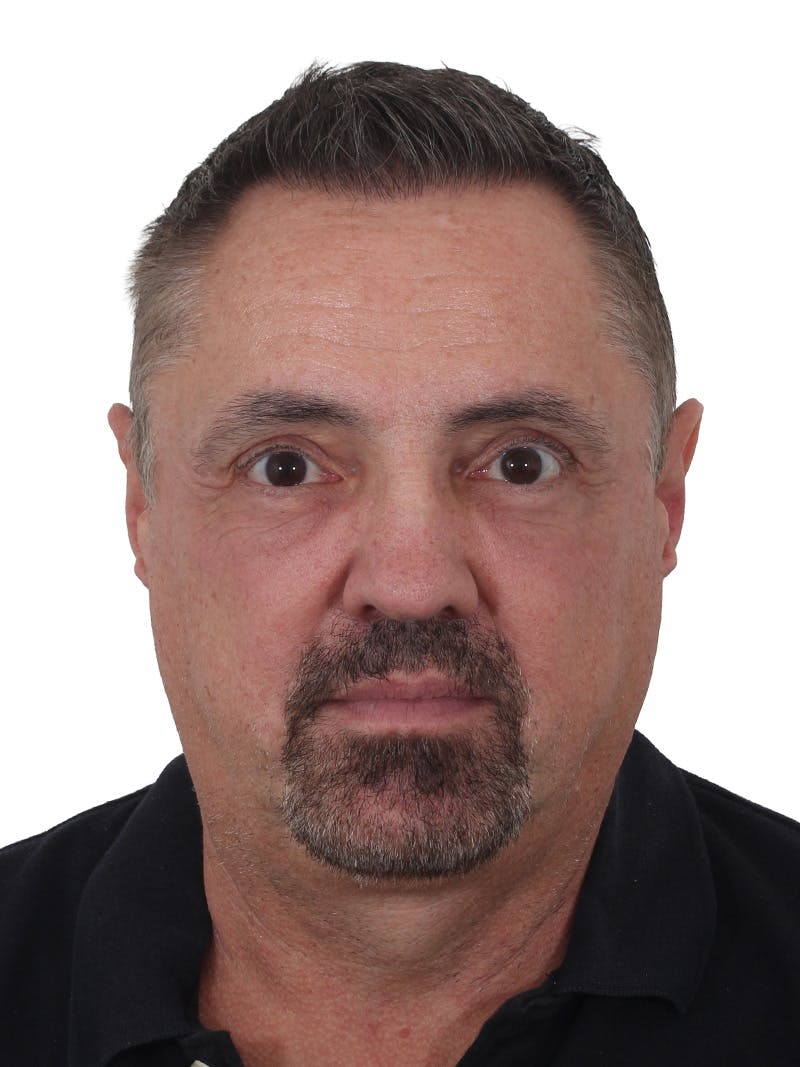 Blepharoplasty Before & After Gallery - Patient 266889 - Image 2