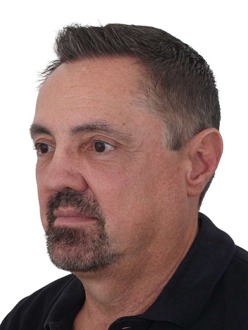 Blepharoplasty Before & After Gallery - Patient 266889 - Image 4