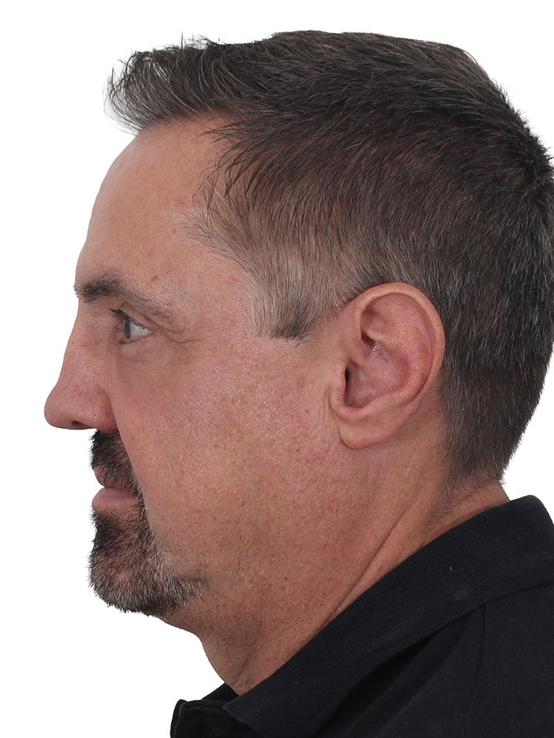Blepharoplasty Before & After Gallery - Patient 266889 - Image 6