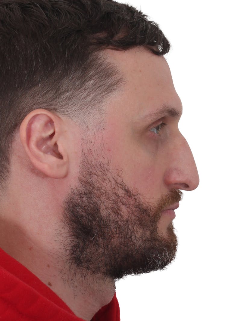 Rhinoplasty Before & After Gallery - Patient 322020 - Image 2