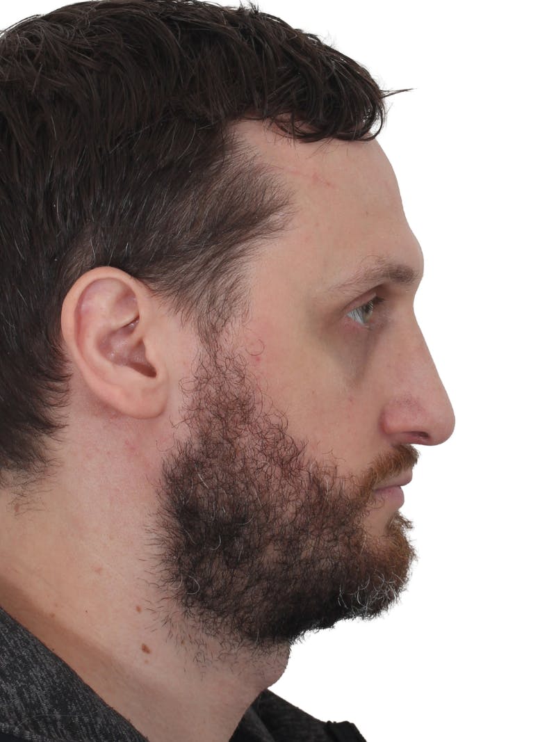 Rhinoplasty Before & After Gallery - Patient 322020 - Image 1