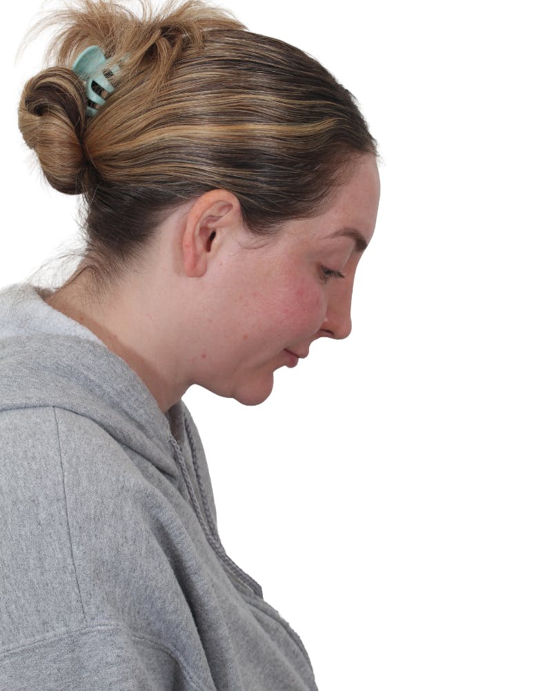 Facelift/Neck Lift Before & After Gallery - Patient 237184 - Image 4