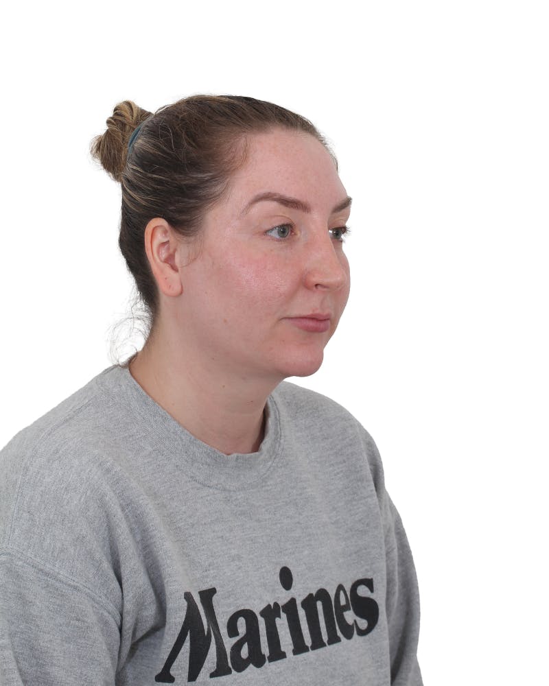 Facelift/Neck Lift Before & After Gallery - Patient 237184 - Image 5