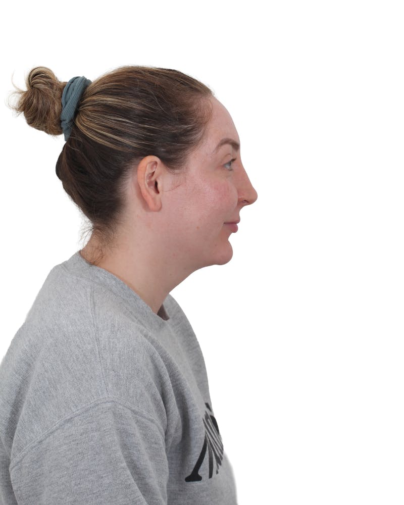 Facelift/Neck Lift Before & After Gallery - Patient 237184 - Image 1