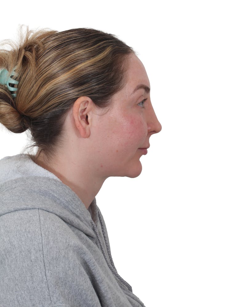Facelift/Neck Lift Before & After Gallery - Patient 237184 - Image 2