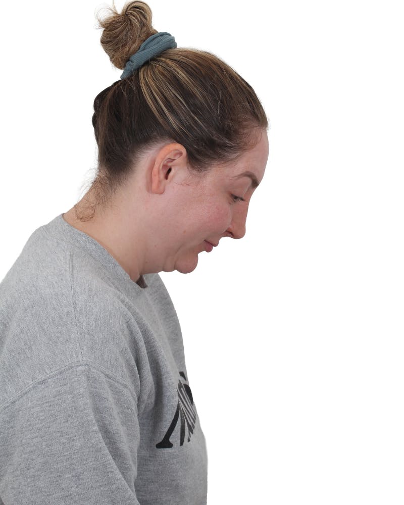 Facelift/Neck Lift Before & After Gallery - Patient 237184 - Image 3