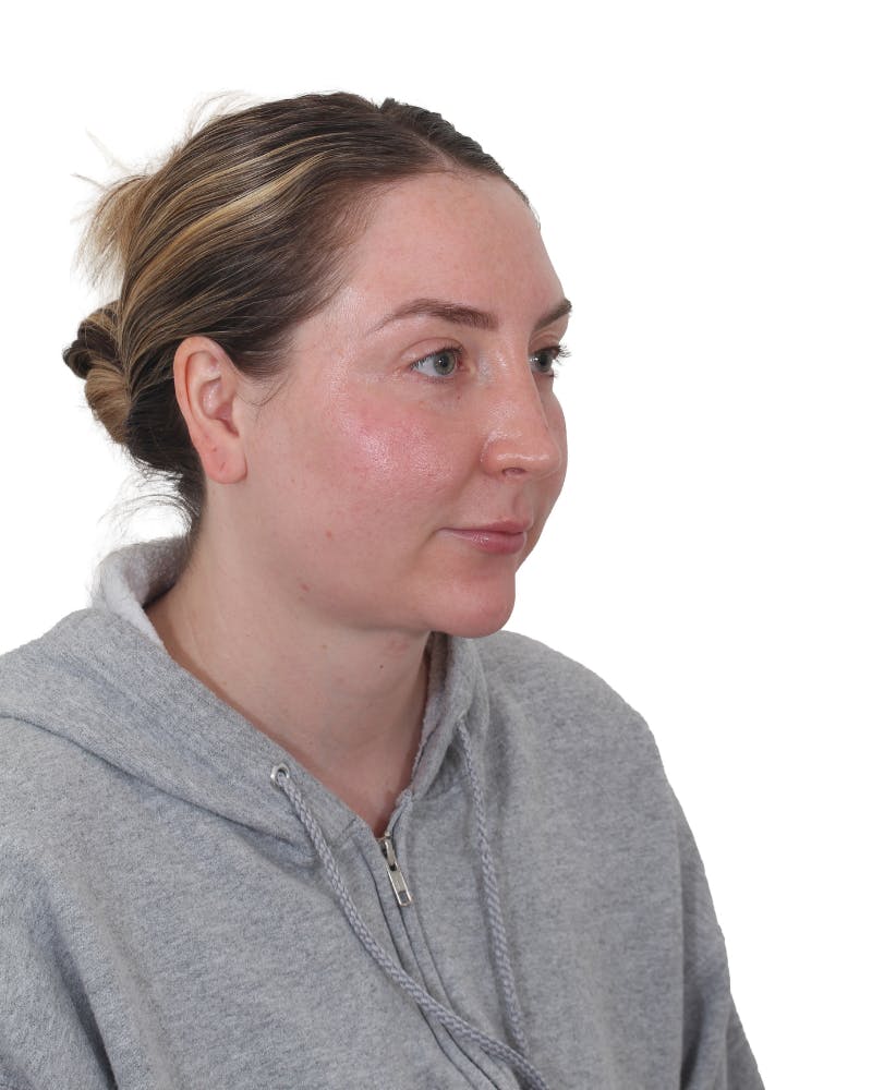 Facelift/Neck Lift Before & After Gallery - Patient 237184 - Image 6