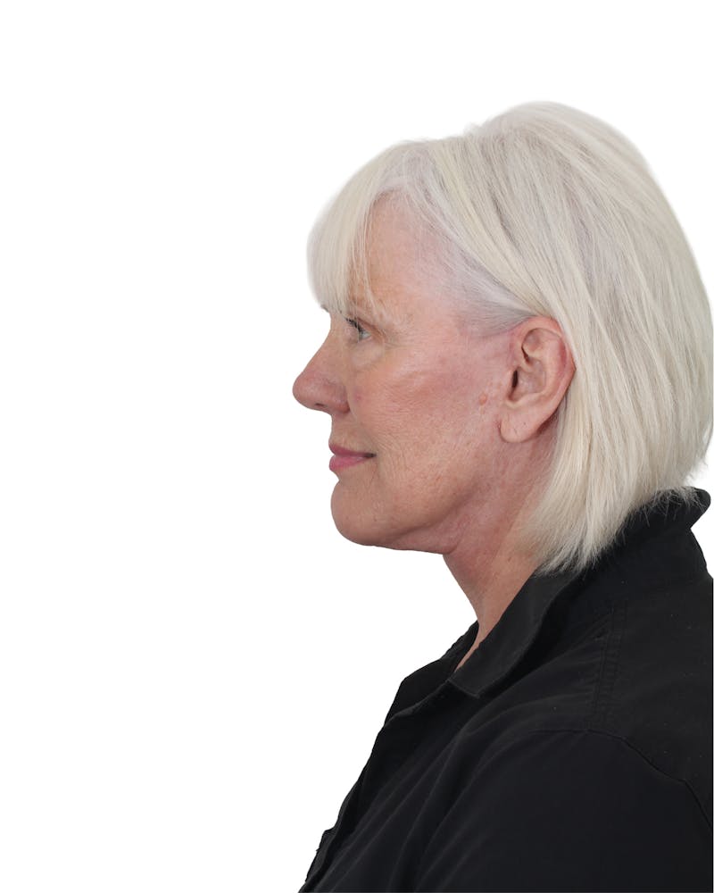 Facelift/Neck Lift Before & After Gallery - Patient 249743 - Image 6