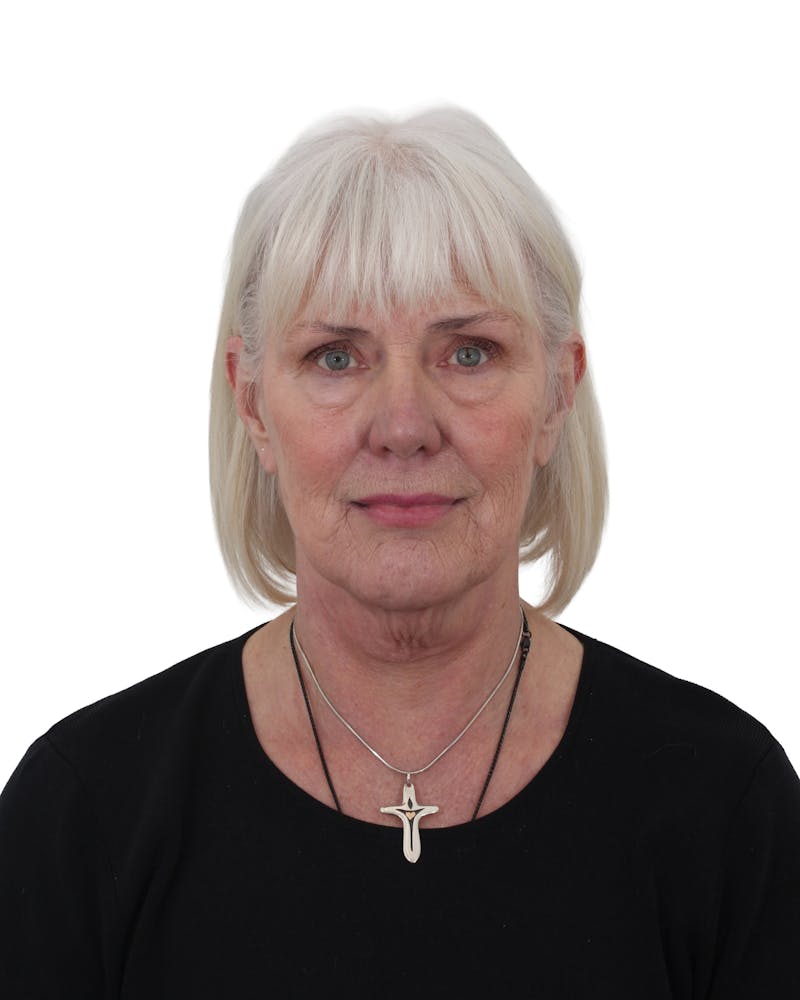 Facelift/Neck Lift Before & After Gallery - Patient 249743 - Image 3