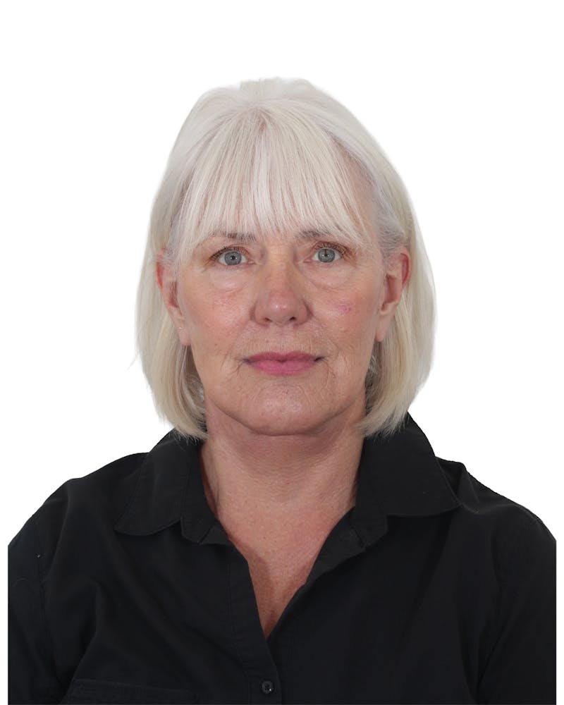 Facelift/Neck Lift Before & After Gallery - Patient 249743 - Image 4