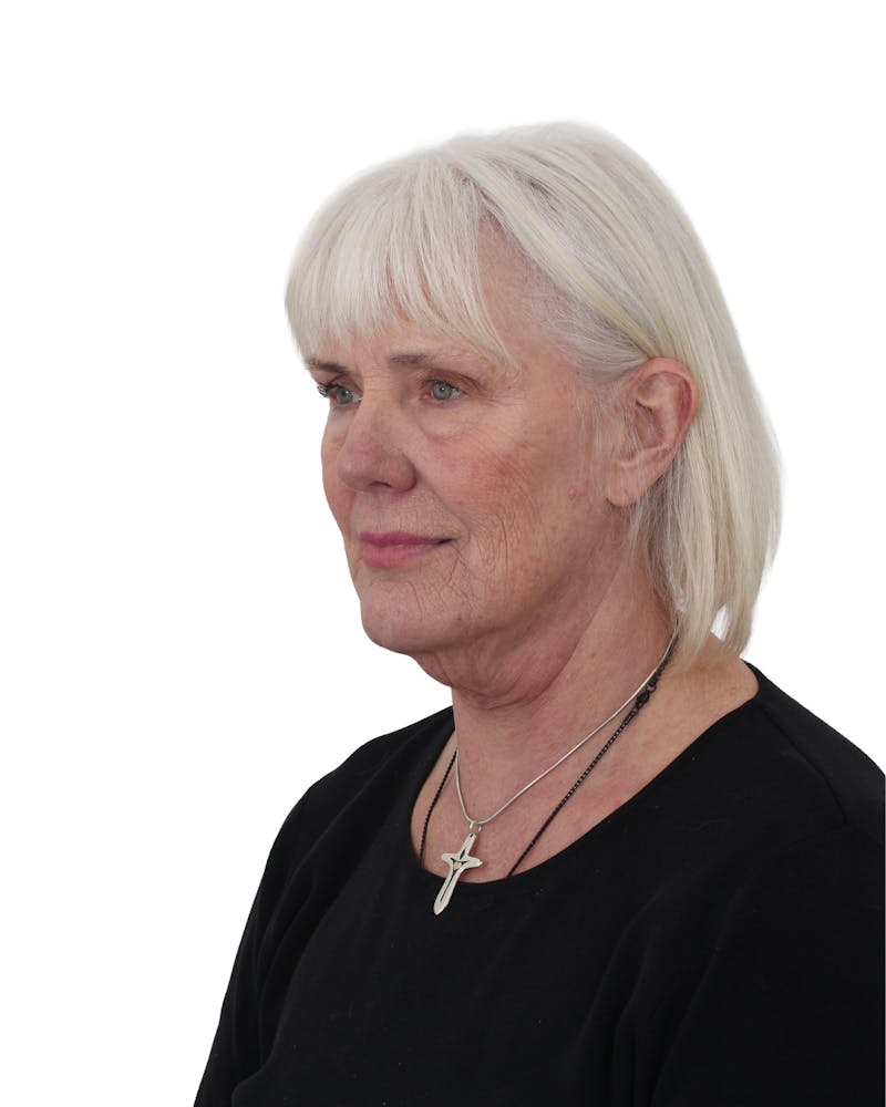 Facelift/Neck Lift Before & After Gallery - Patient 249743 - Image 1