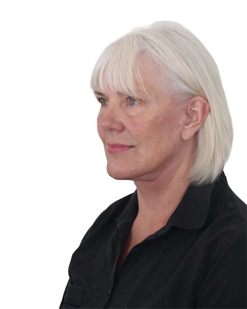 Facelift/Neck Lift Before & After Gallery - Patient 249743 - Image 2