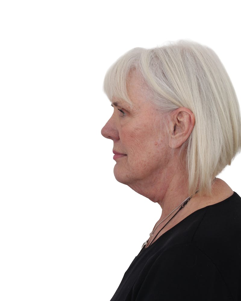Facelift/Neck Lift Before & After Gallery - Patient 249743 - Image 5