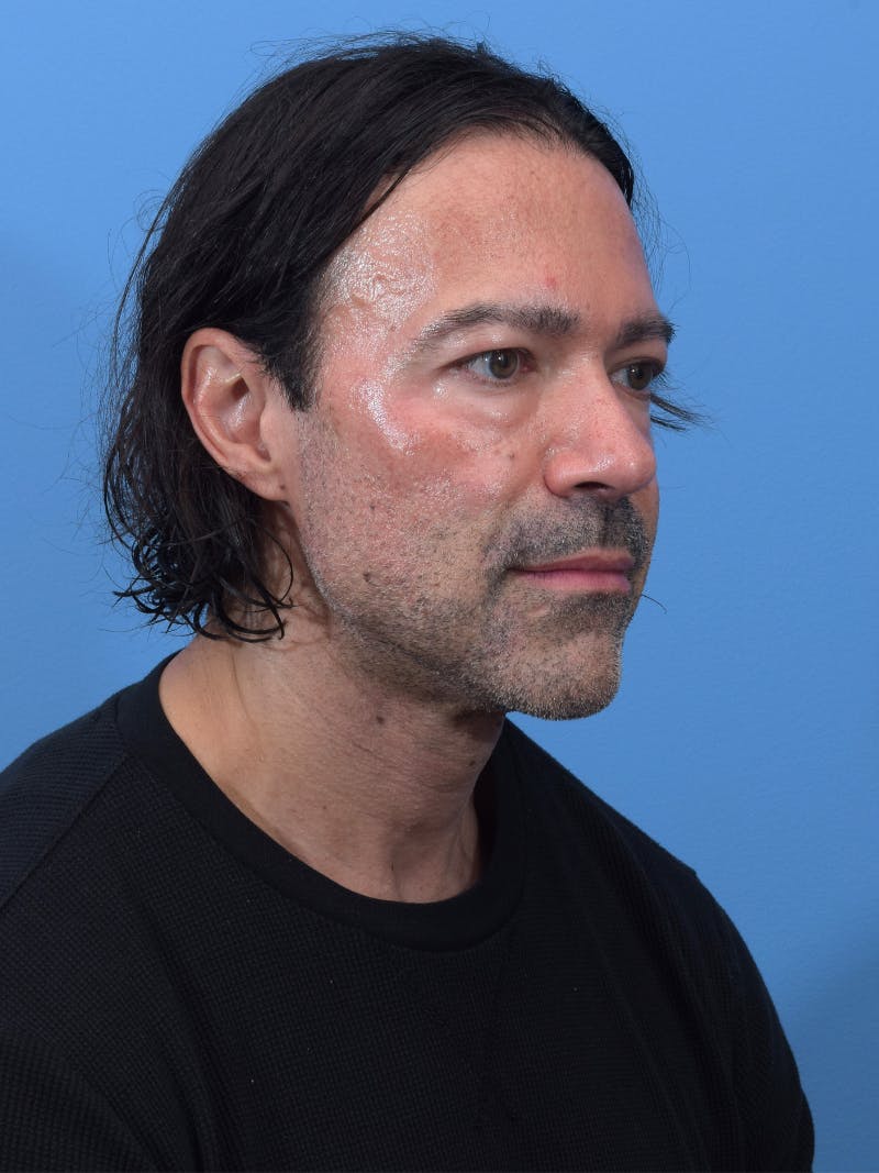 Rhinoplasty Before & After Gallery - Patient 107404 - Image 4