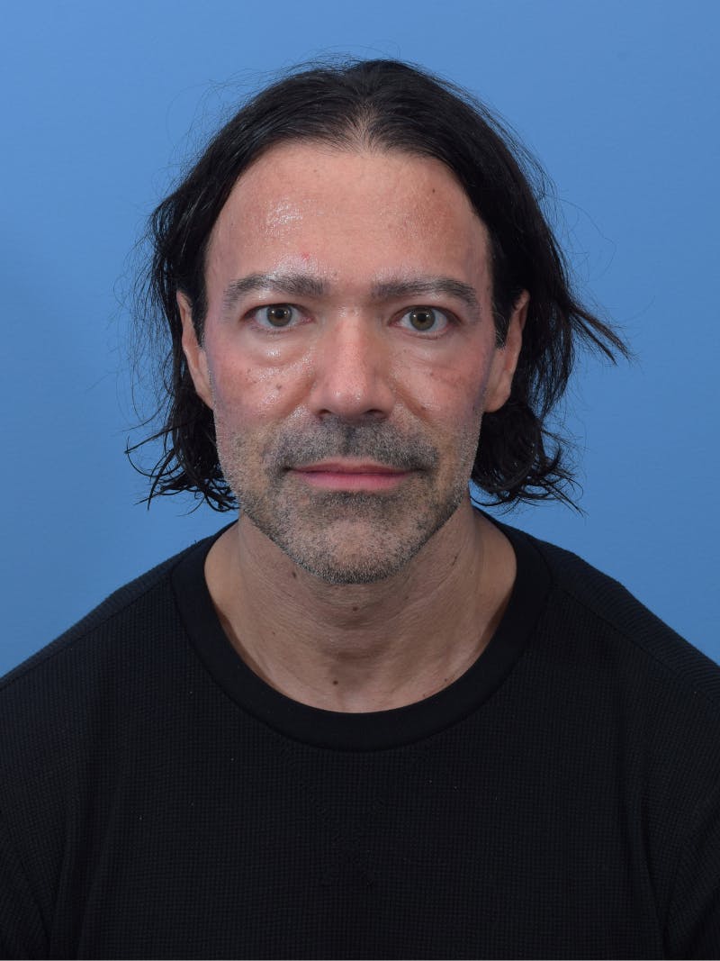Rhinoplasty Before & After Gallery - Patient 107404 - Image 6