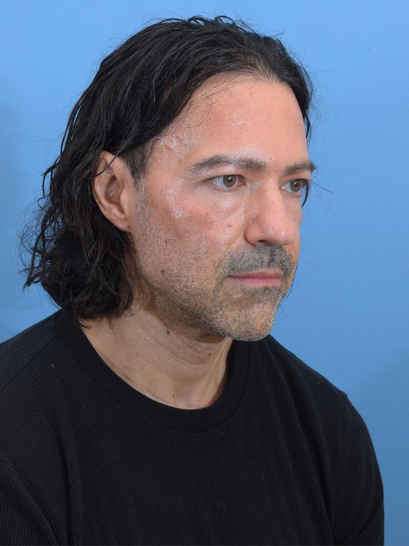 Rhinoplasty Before & After Gallery - Patient 107404 - Image 3