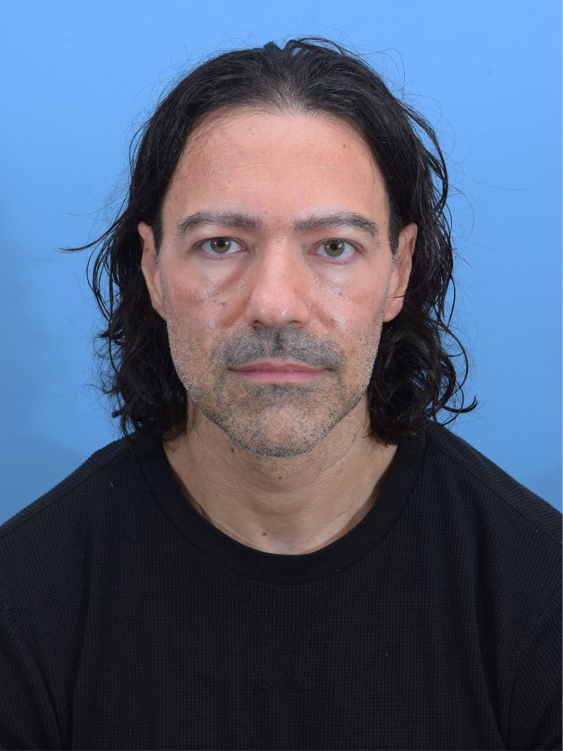 Rhinoplasty Before & After Gallery - Patient 107404 - Image 5