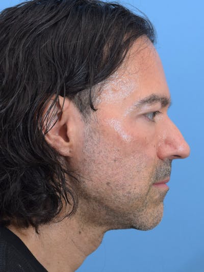 Rhinoplasty Before & After Gallery - Patient 107404 - Image 1