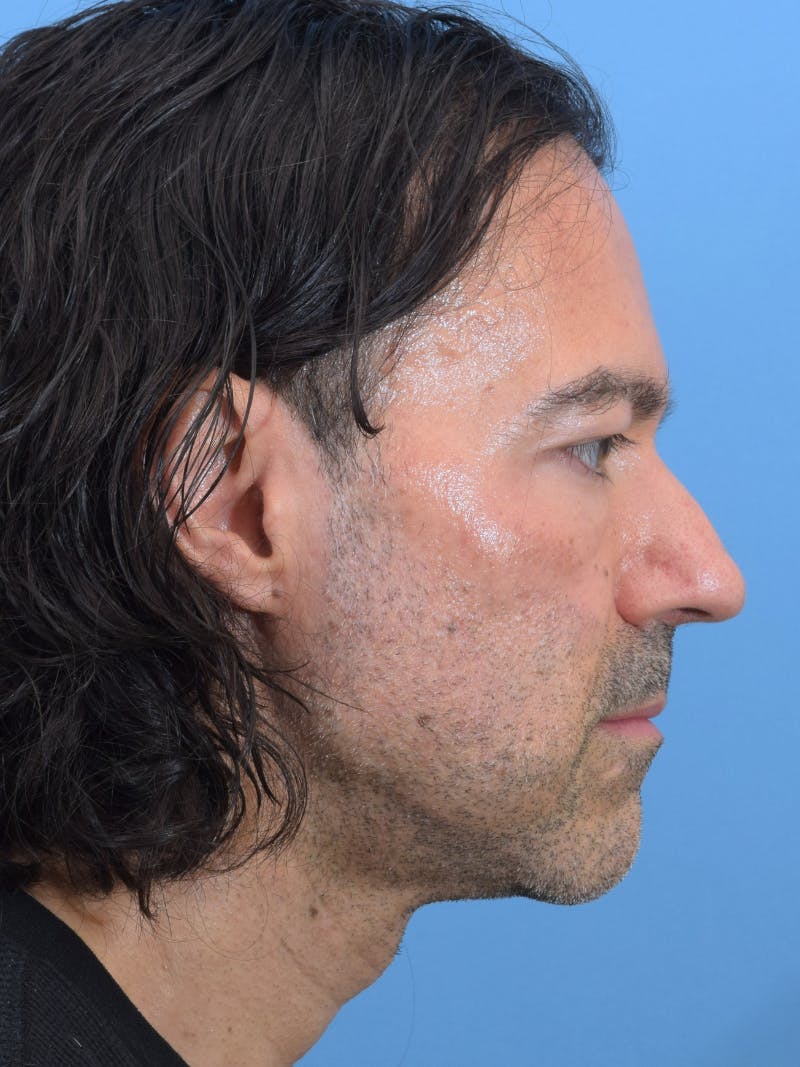 Rhinoplasty Before & After Gallery - Patient 107404 - Image 1
