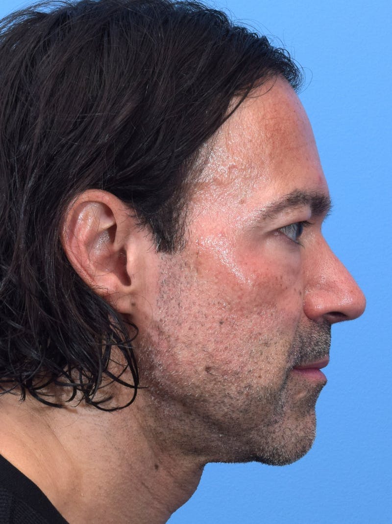 Rhinoplasty Before & After Gallery - Patient 107404 - Image 2