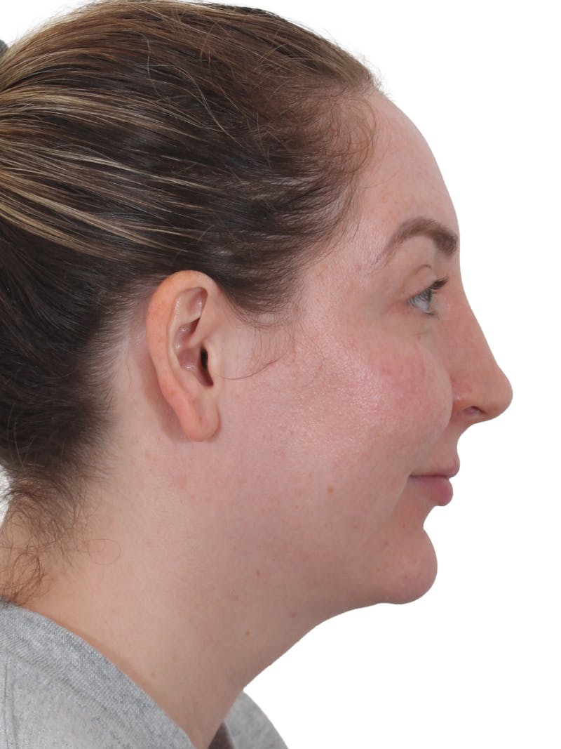Facelift/Neck Lift Before & After Gallery - Patient 237184 - Image 1