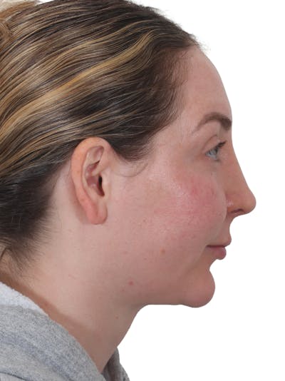 Facelift/Neck Lift Before & After Gallery - Patient 237184 - Image 2