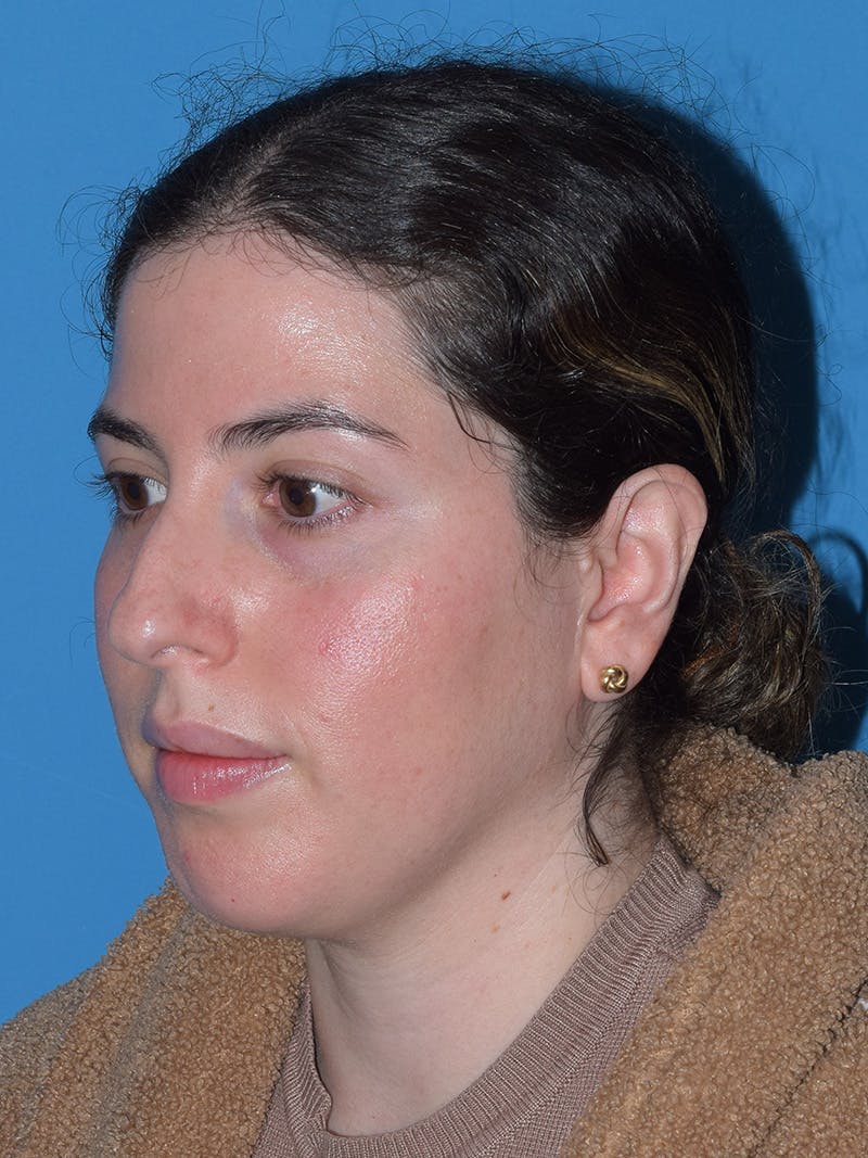 Chin Augmentation Before & After Gallery - Patient 188458 - Image 1