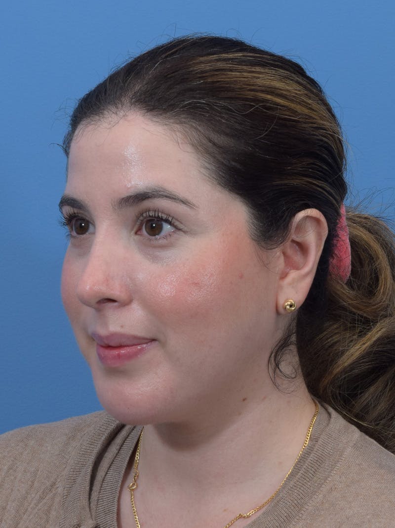 Chin Augmentation Before & After Gallery - Patient 188458 - Image 2
