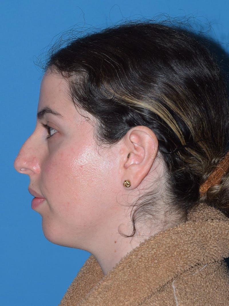 Chin Augmentation Before & After Gallery - Patient 188458 - Image 3