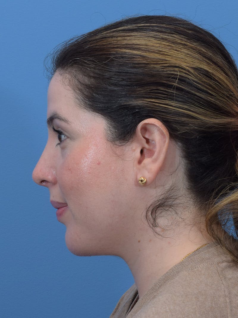 Chin Augmentation Before & After Gallery - Patient 188458 - Image 4