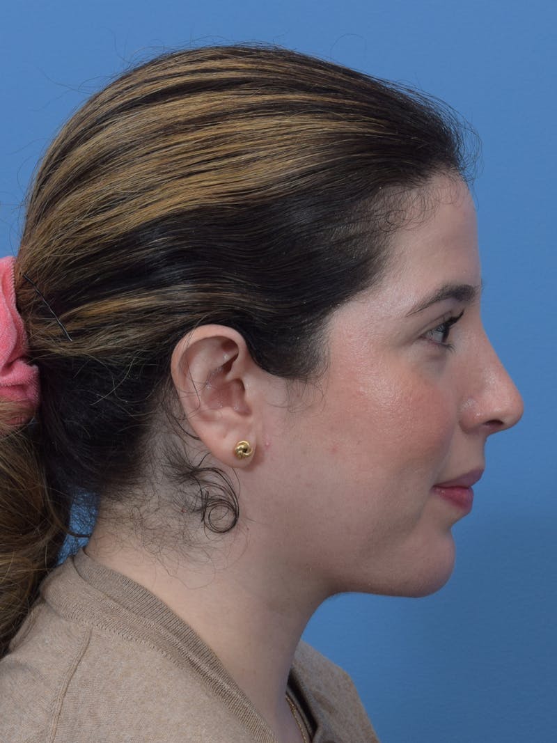 Chin Augmentation Before & After Gallery - Patient 300288 - Image 10