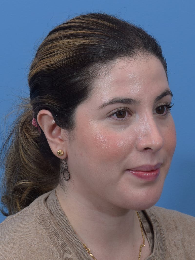 Chin Augmentation Before & After Gallery - Patient 300288 - Image 8