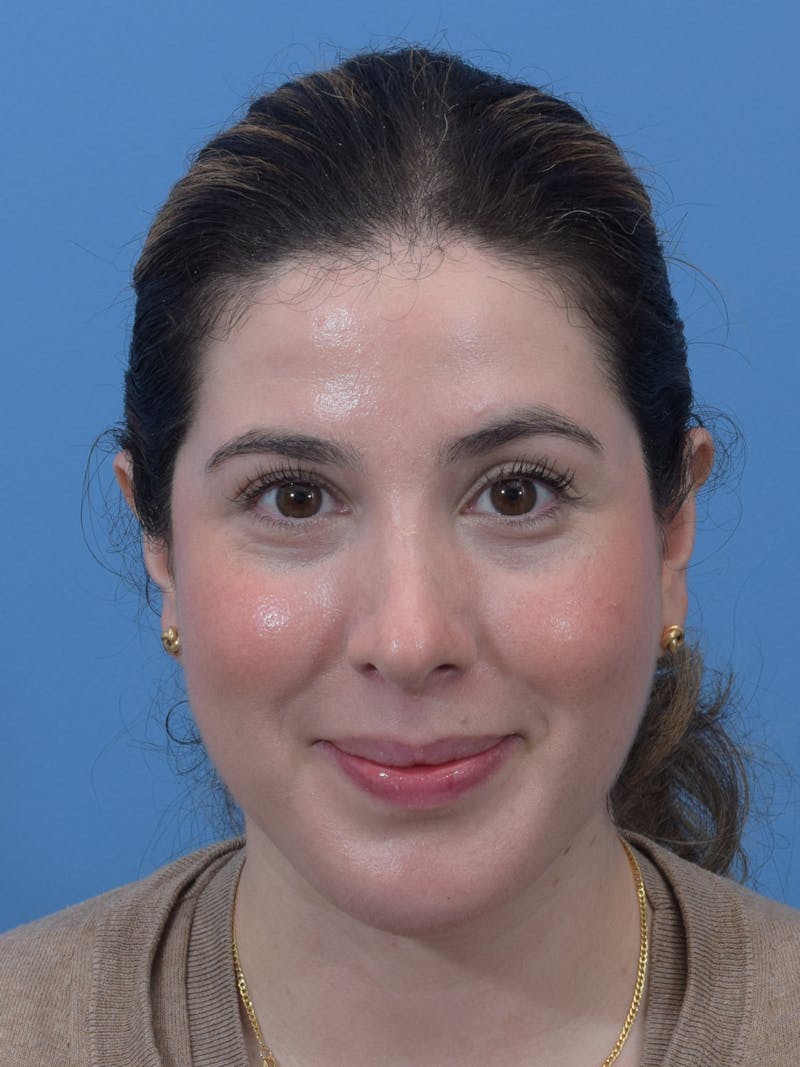 Chin Augmentation Before & After Gallery - Patient 300288 - Image 6
