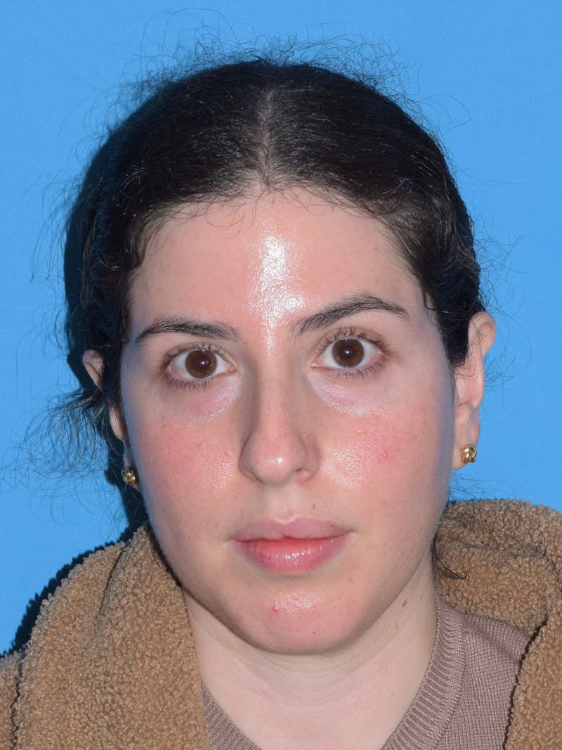 Chin Augmentation Before & After Gallery - Patient 300288 - Image 5
