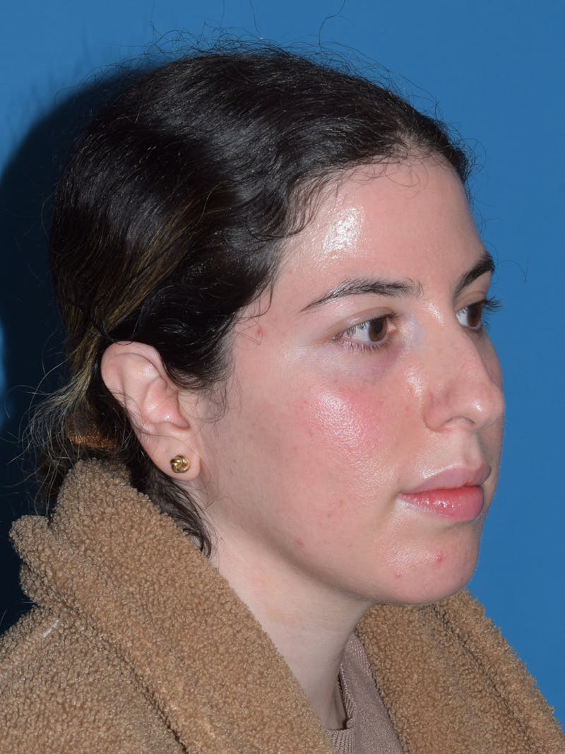 Chin Augmentation Before & After Gallery - Patient 300288 - Image 7
