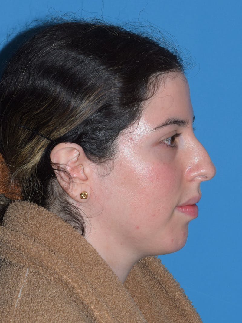 Chin Augmentation Before & After Gallery - Patient 300288 - Image 9