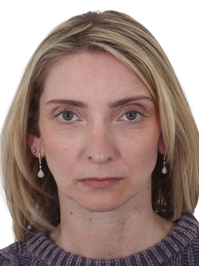 Rhinoplasty Before & After Gallery - Patient 177144 - Image 5