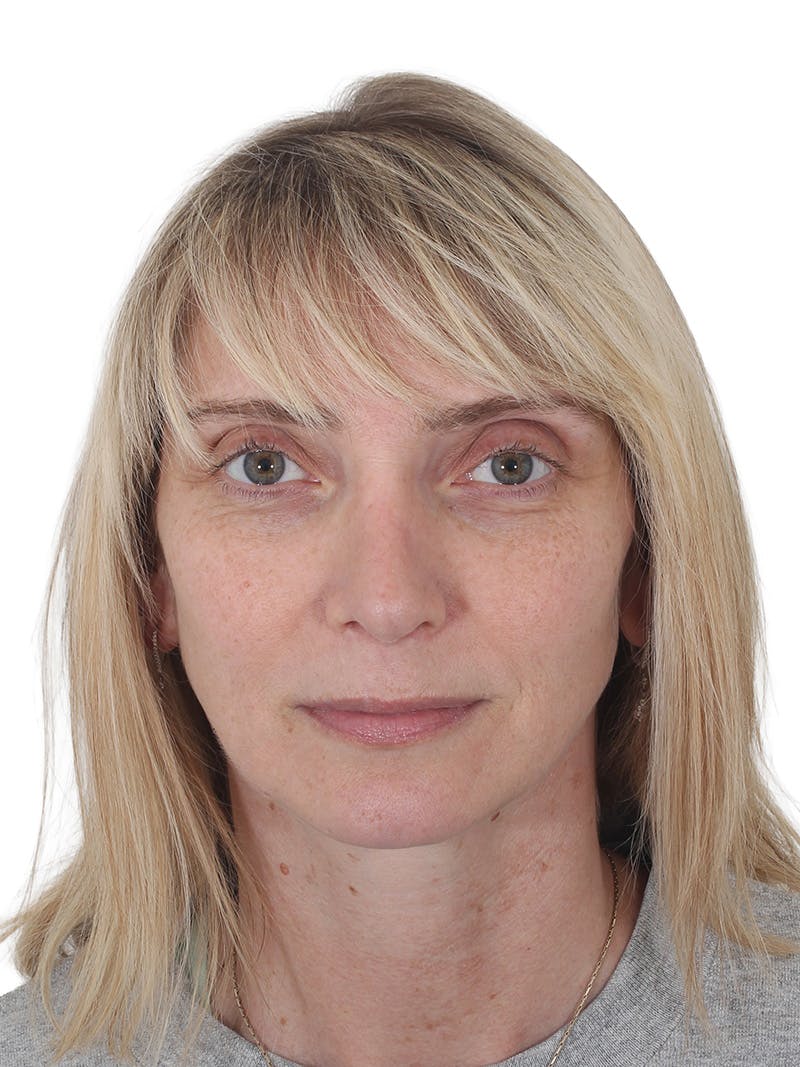 Rhinoplasty Before & After Gallery - Patient 177144 - Image 6