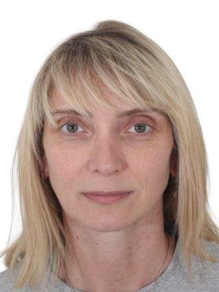 Rhinoplasty Before & After Gallery - Patient 177144 - Image 6