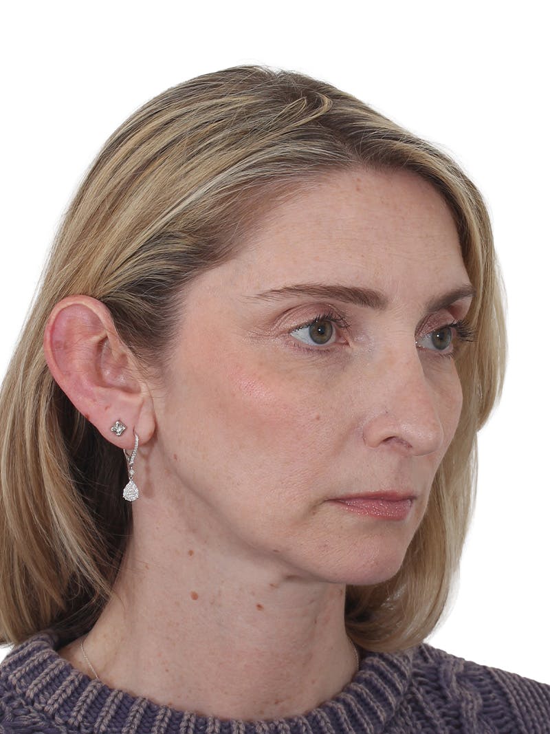 Rhinoplasty Before & After Gallery - Patient 177144 - Image 3