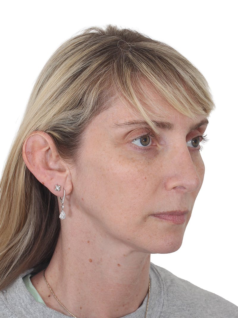 Rhinoplasty Before & After Gallery - Patient 177144 - Image 4