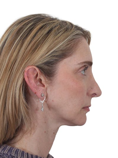 Rhinoplasty Before & After Gallery - Patient 177144 - Image 1
